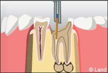 traitement radiculaire